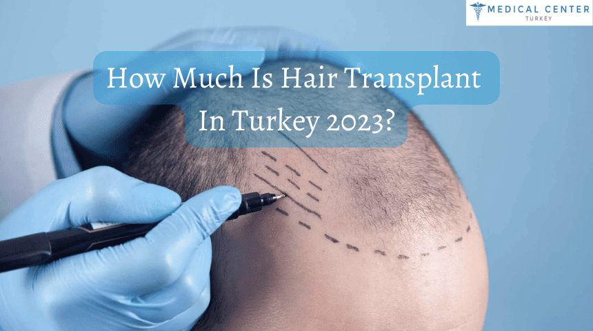 How Much Is Hair Transplant In Turkey 2023?