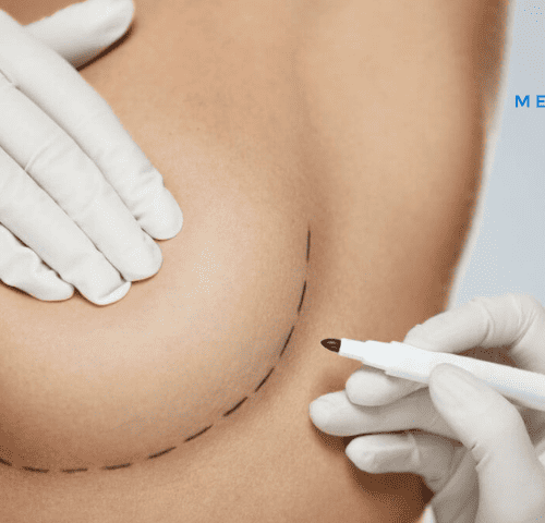 How Often Should Breast Implants Be Replaced