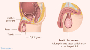 How Testicular Cancer is Treated