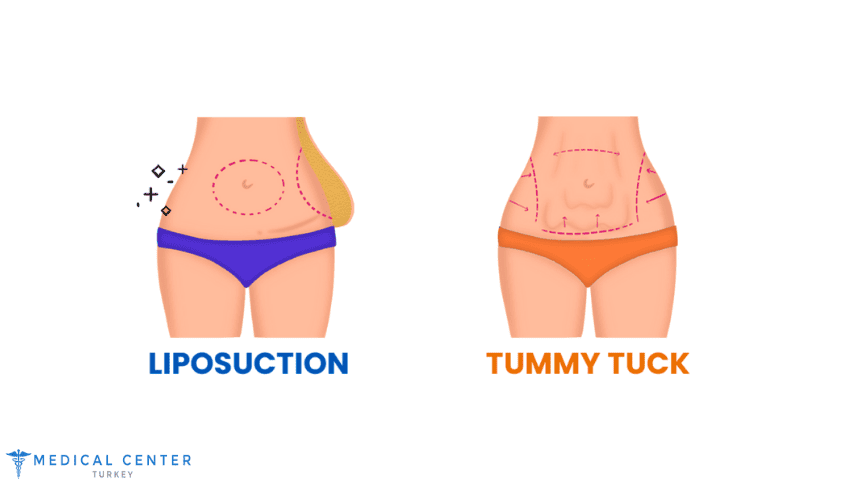 How Much Does Liposuction and A Tummy Tuck Cost - MCT