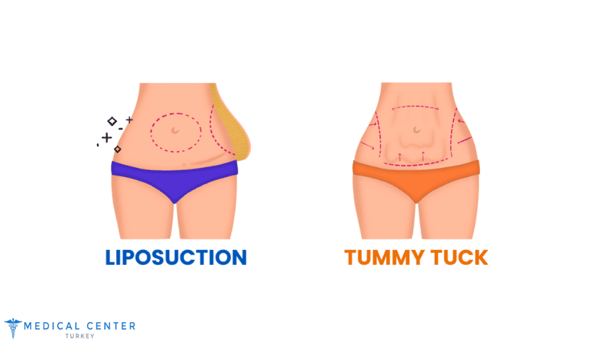 How Much Does Liposuction and A Tummy Tuck Cost