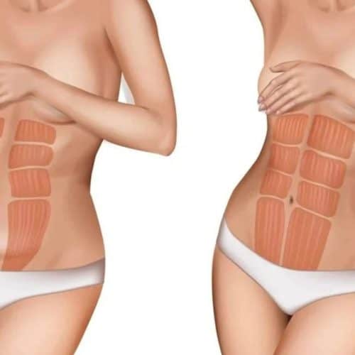 How Much Does Liposuction and A Tummy Tuck Cost How Much Does Liposuction and A Tummy Tuck Cost