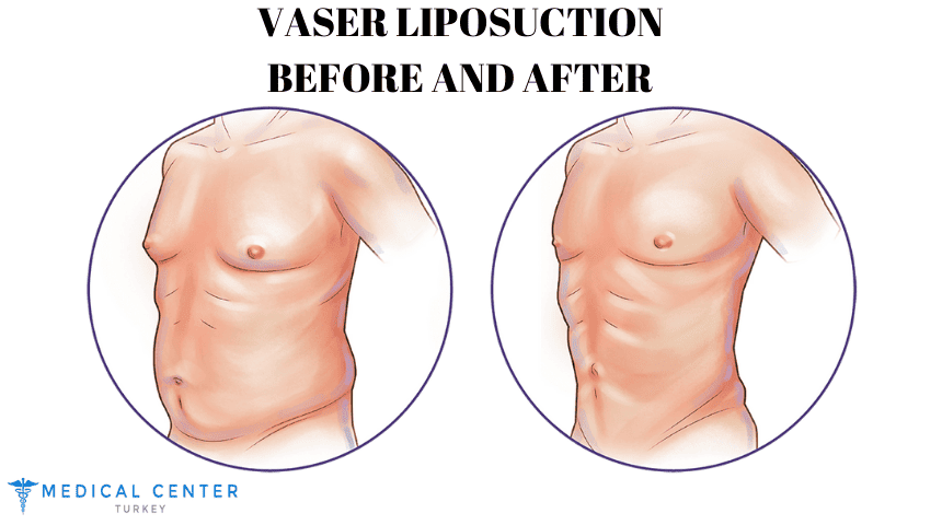 Vaser Liposuction Turkey Before and After