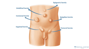 How To Get Hernia Surgery Without Insurance