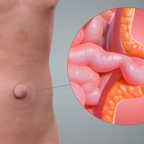 How To Get Hernia Surgery Without Insurance