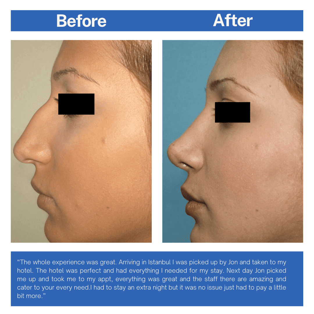 Rhinoplast (Nose Job) Before and After Turkey