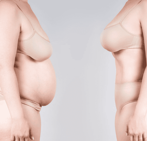 How Much Is A Mommy Makeover