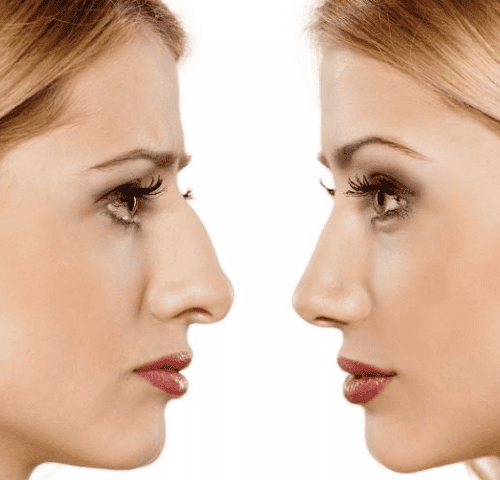 Rhinoplast (Nose Job) Before and After