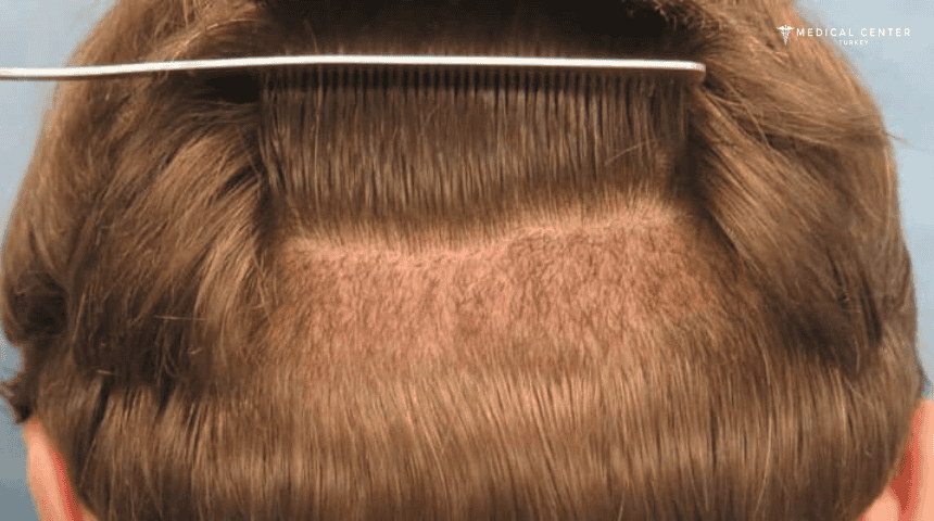 A Guide to Hair Transplant Success Rates A Guide to Hair Transplant Success Rates