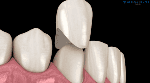 How Long Does a Dental Crown Last?