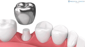 How Long Does a Dental Crown Last?