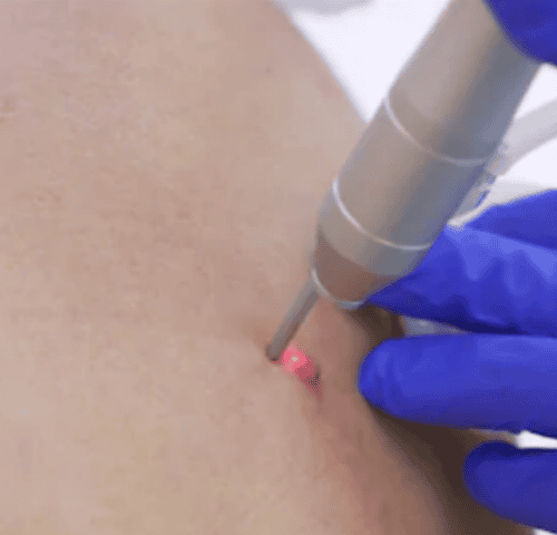 What is the cost of mole removal in Turkey?