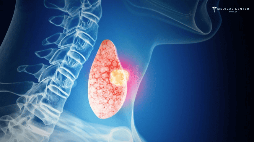Thyroid Cancer Thyroid Cancer