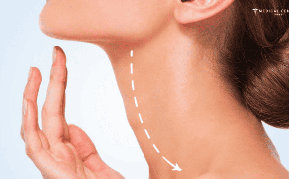 Neck Lift Cost in Turkey