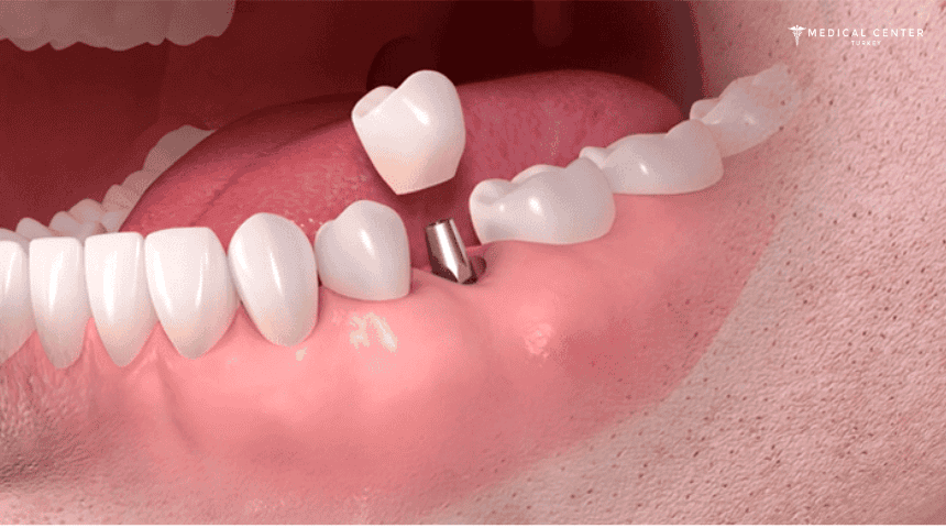 Dental Implants in Turkey: Types, Prices, Procedures Dental Implants in Turkey: Types, Prices, Procedures