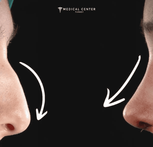 Why Turkish Rhinoplasty surgery Is So Popular?