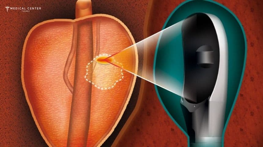 HIFU for Prostate Cancer in Turkey HIFU for Prostate Cancer in Turkey