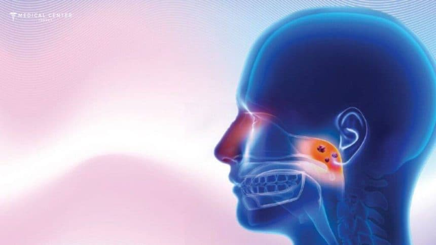 Nasopharyngeal Cancer Nasopharyngeal Cancer