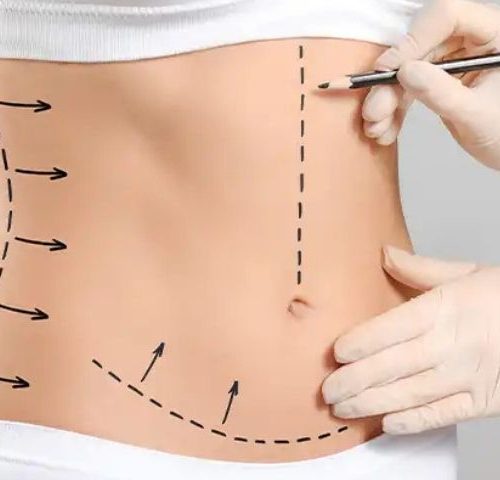 Body Mass Index (BMI) for Liposuction
