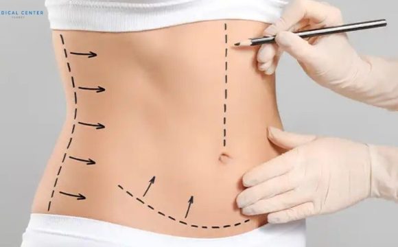 Body Mass Index (BMI) for Liposuction