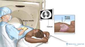 Lung Cancer Surgery in Turkey
