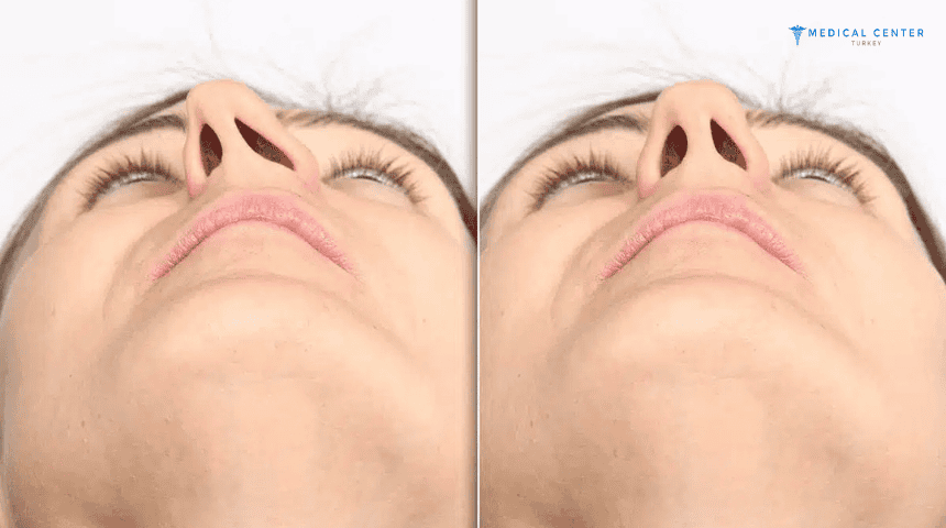 Septoplasty in Turkey Septoplasty in Turkey
