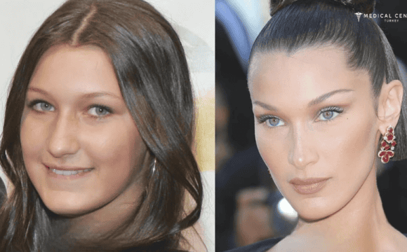 Bella Hadid’s Rhinoplasty Surgery