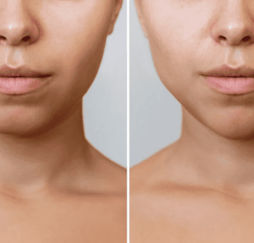 Bichectomy Surgery in Turkey