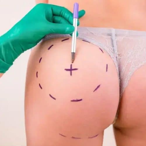 How much is Butt Lift in Turkey? How much is Butt Lift in Turkey?