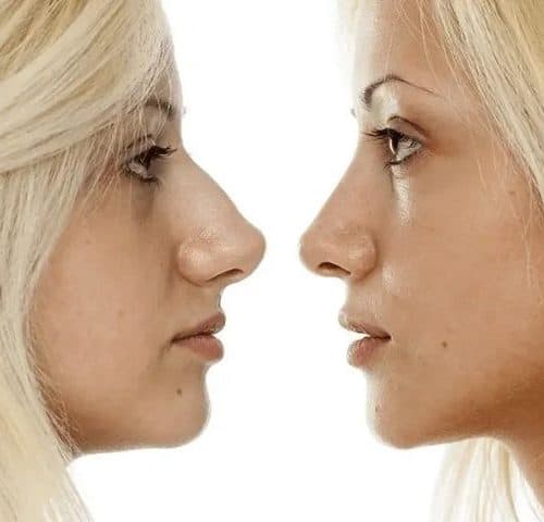 Cheapest Countries For Nose Job