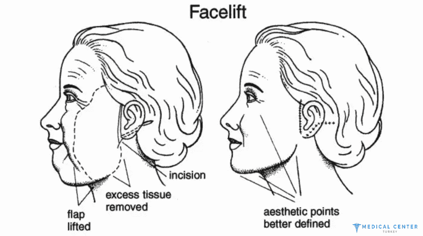 The Complete Guide to Facelift Surgery - Medical Center Turkey
