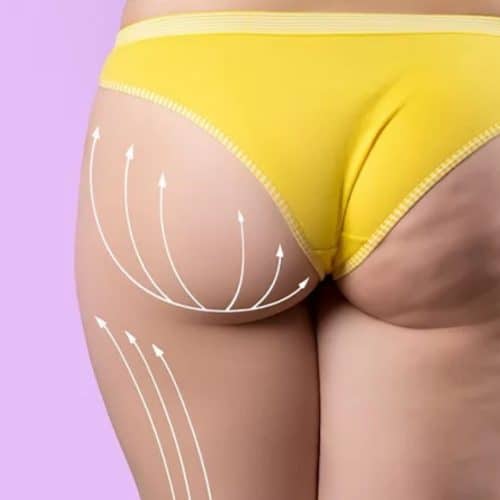 BBL Healing Time in Turkey BBL Healing Time in Turkey