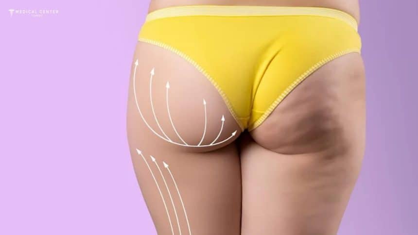 BBL Healing Time in Turkey