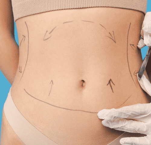 Liposuction Healing Time