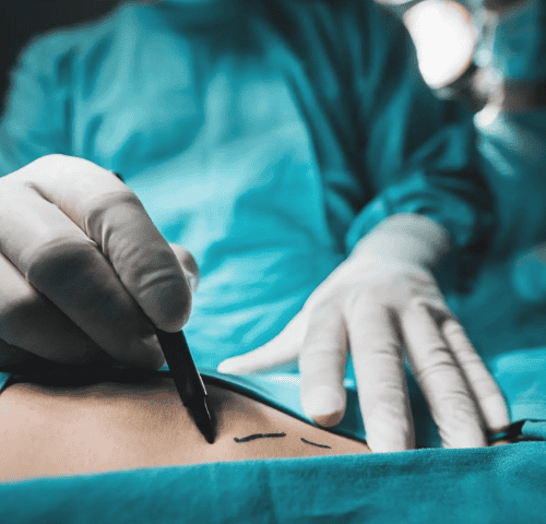 The Best Hospital for Liposuction in Turkey