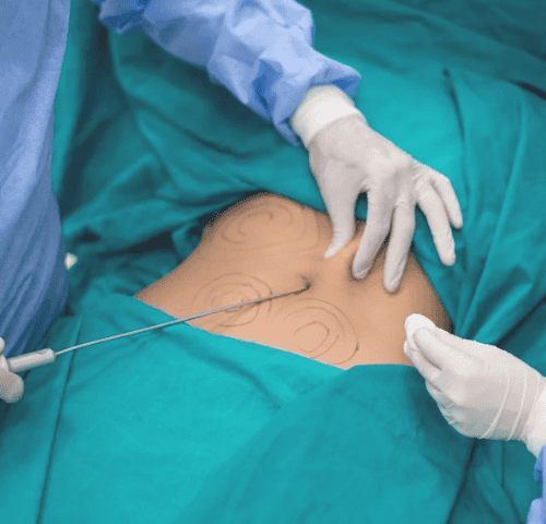 Is Liposuction Painful?