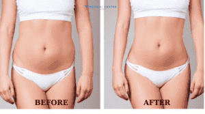 Liposuction Healing Time