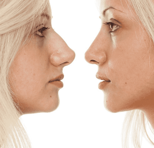 Is Turkey the Best Destination for Rhinoplasty?