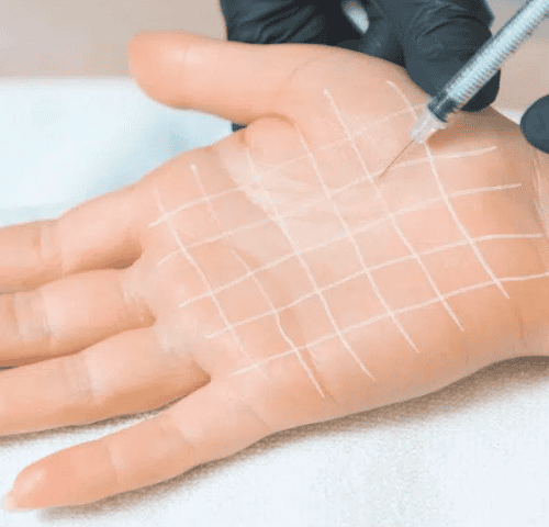 Botox for Hand Sweat Botox for Hand Sweat