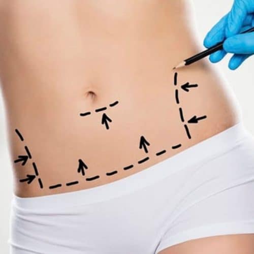 Liposuction Costs in Turkey 2024