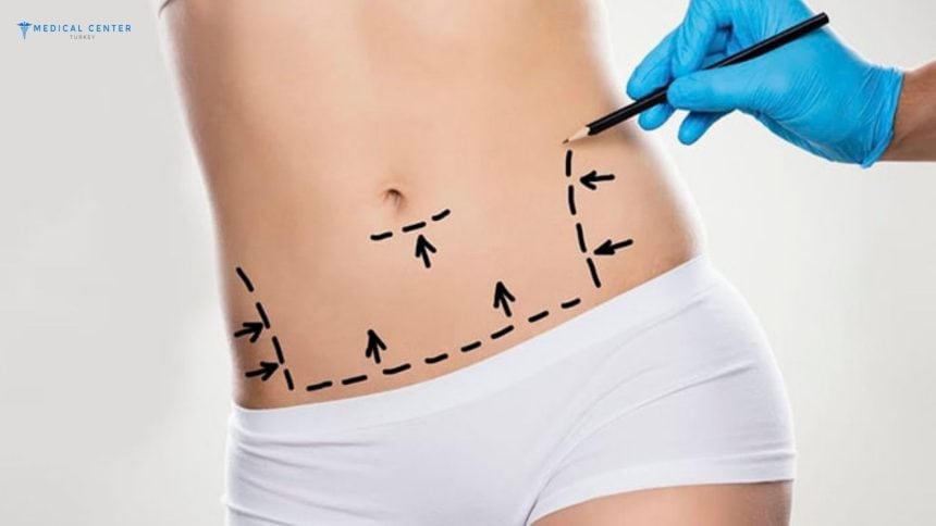 Liposuction Costs in Turkey 2024