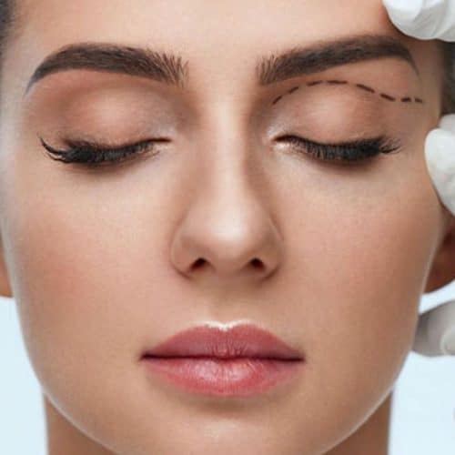 Eyelid Surgery (Blepharoplasty) Techniques in Turkey