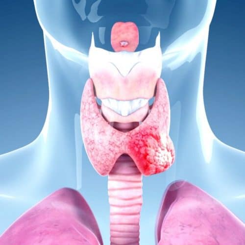 Thyroid Cancer Treatment in Turkey Thyroid Cancer Treatment in Turkey