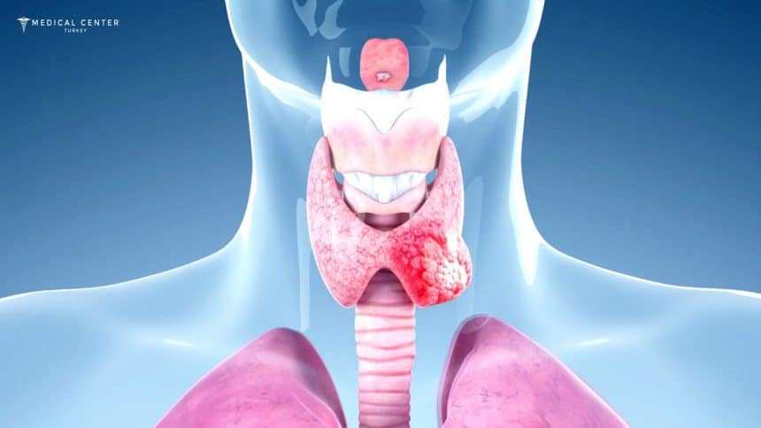 Thyroid Cancer Treatment in Turkey Thyroid Cancer Treatment in Turkey