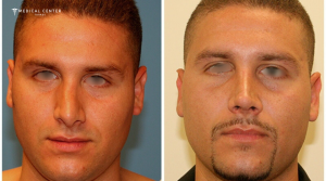 Latest Nose Surgery Techniques in Turkey