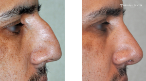 What You Need to Know Before Getting a Nose Surgery