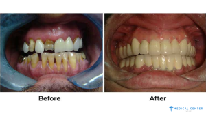 Dental Implants in Turkey 