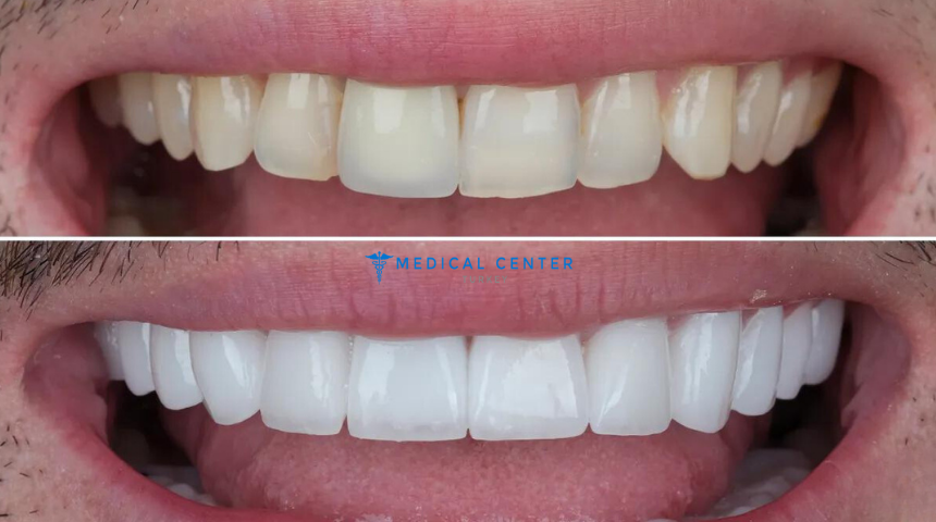What to Know Before Getting a Dental Makeover in Turkey 2025