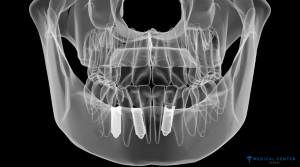 Teeth for dental implants