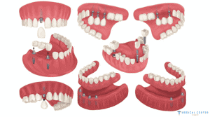 Dental Implants in Turkey Types, Prices, Procedures (4)